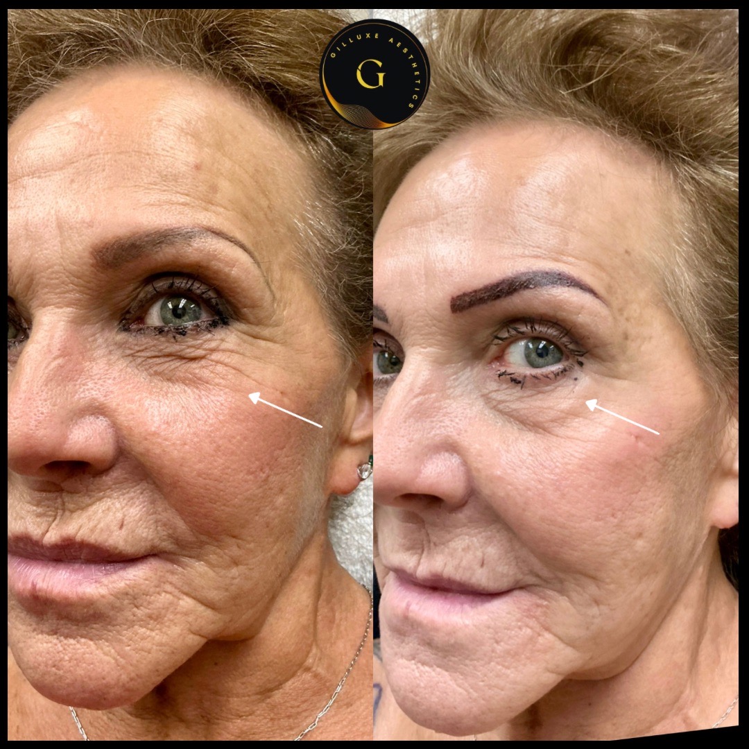 Skin Tightening Face