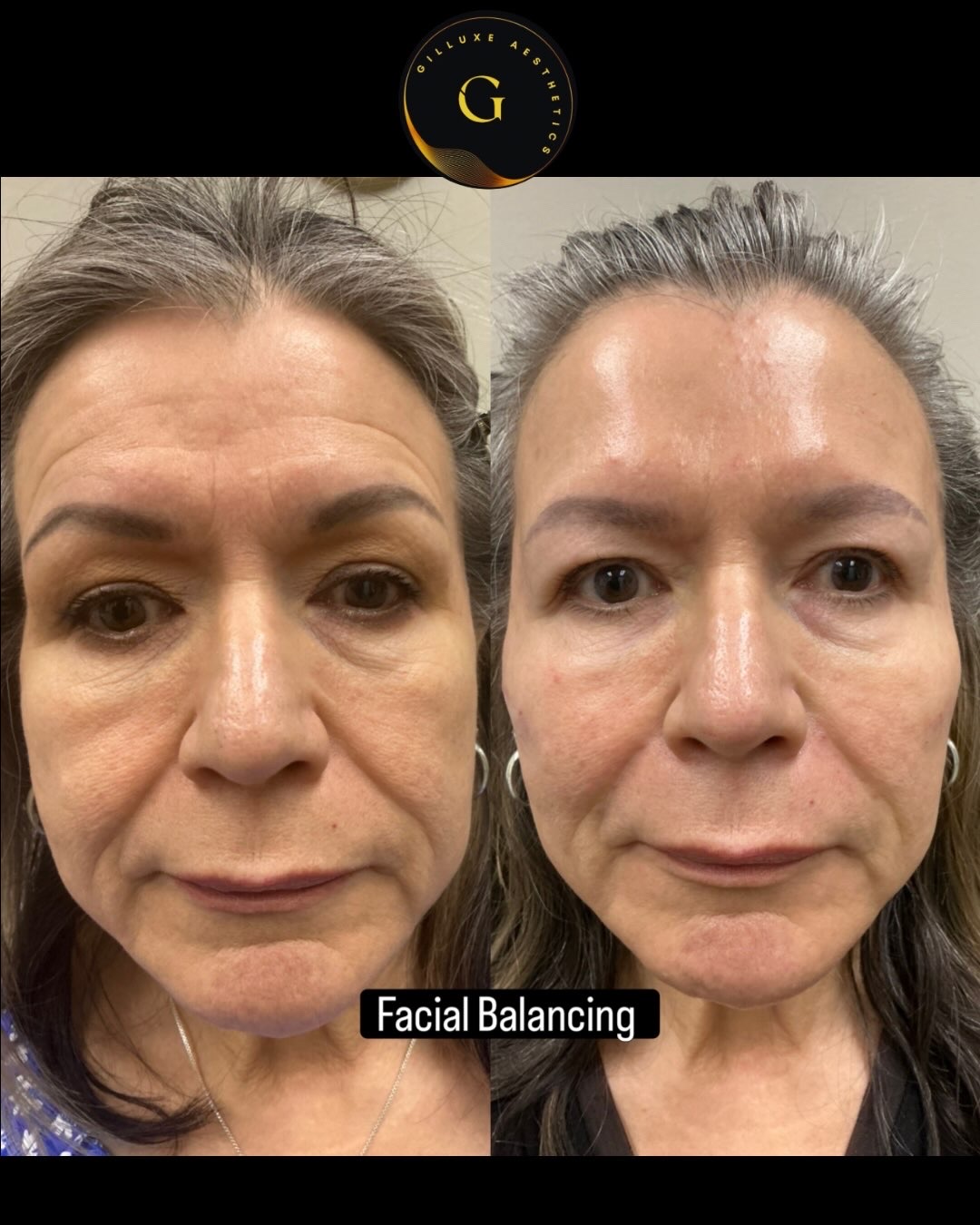 Skin Tightening Face