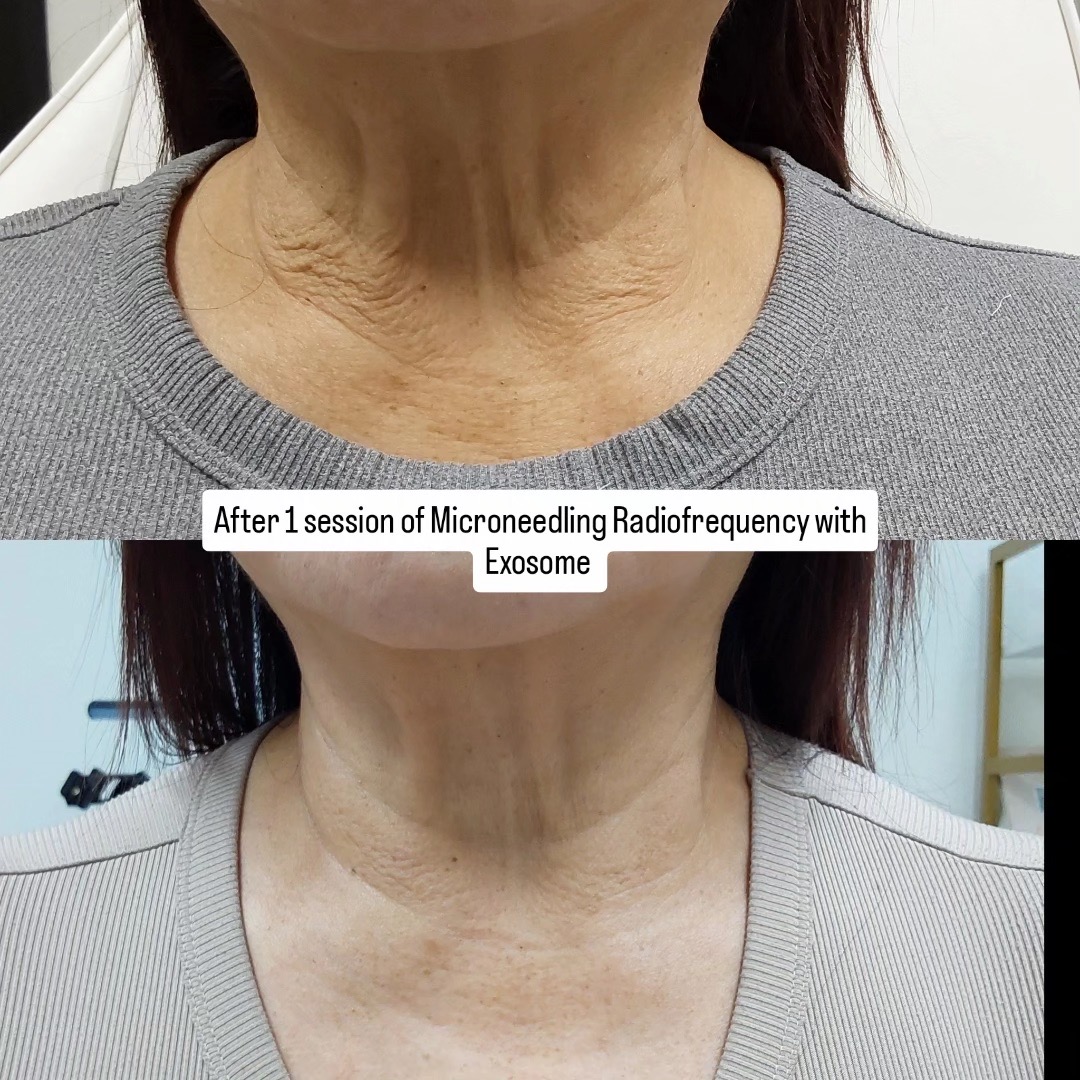Neck RF Treatment