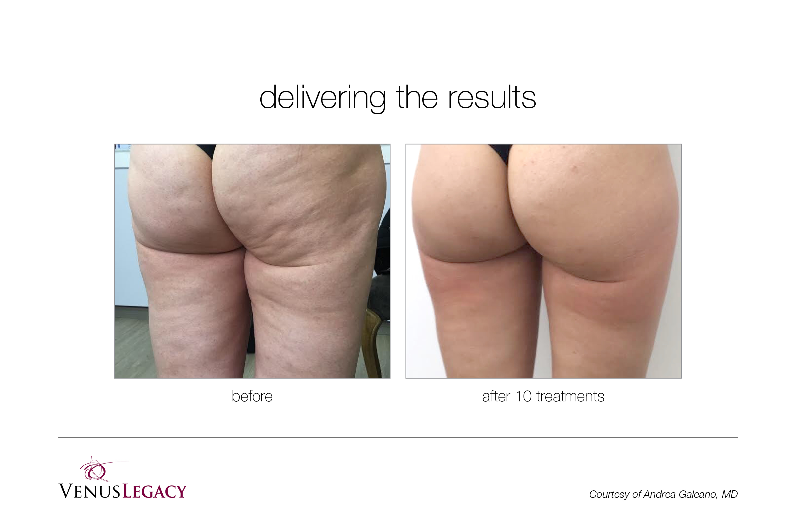 Venus Legacy- Large area (abs, glutes, thighs)