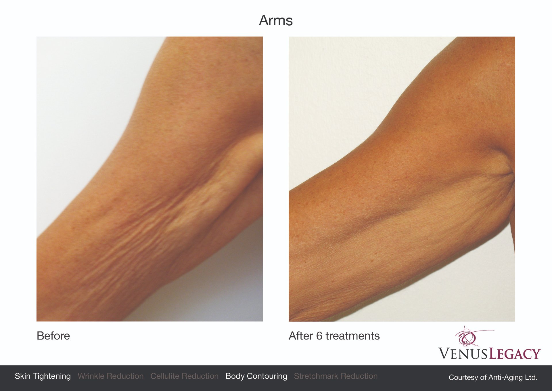 Venus Legacy- Medium area (arms, face/neck)