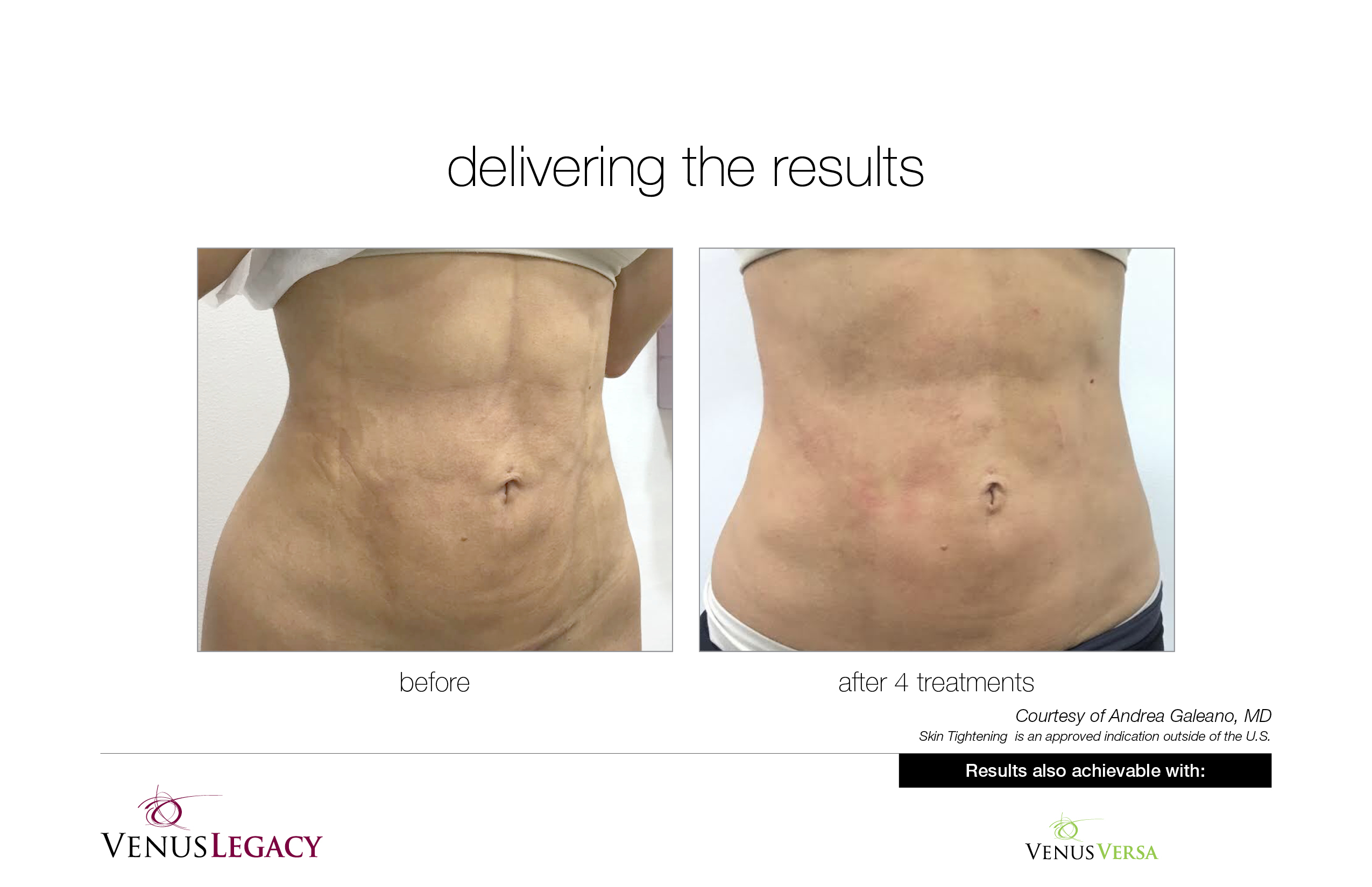 Venus Legacy- Large area (abs, glutes, thighs)