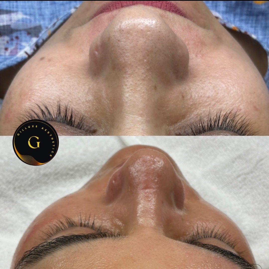 Skin Tightening Face
