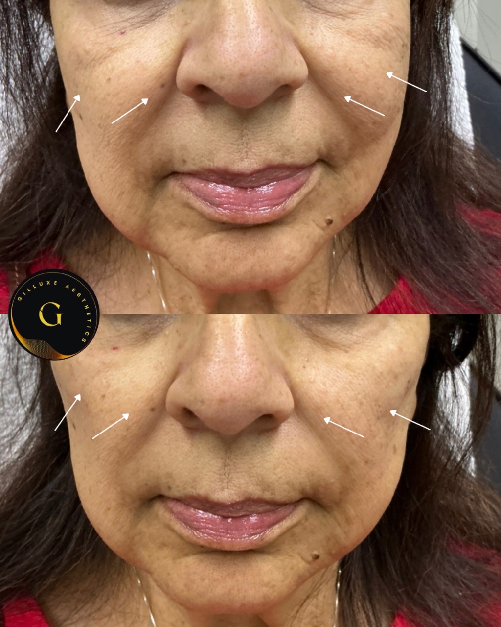 Skin Tightening Face