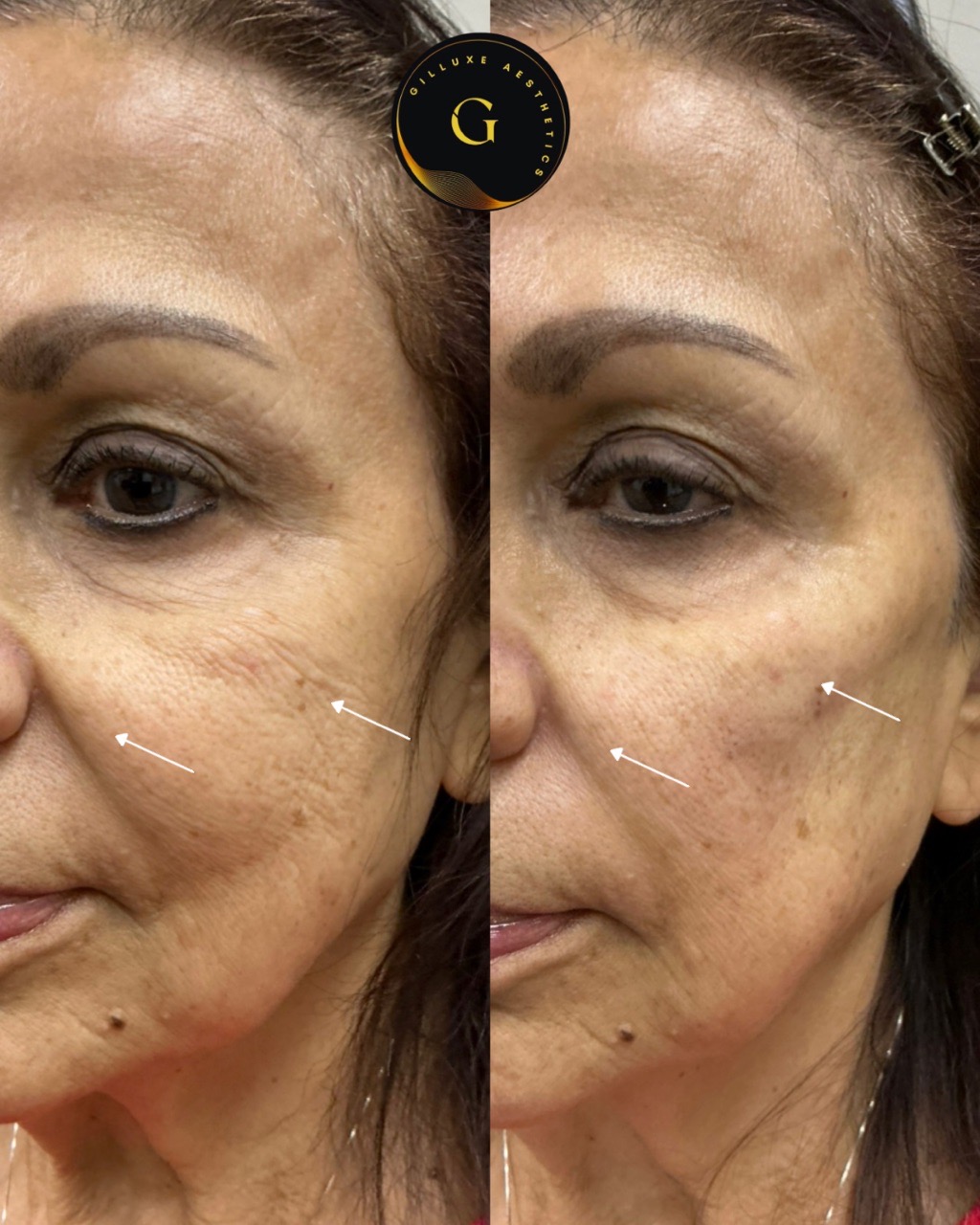 Skin Tightening Face