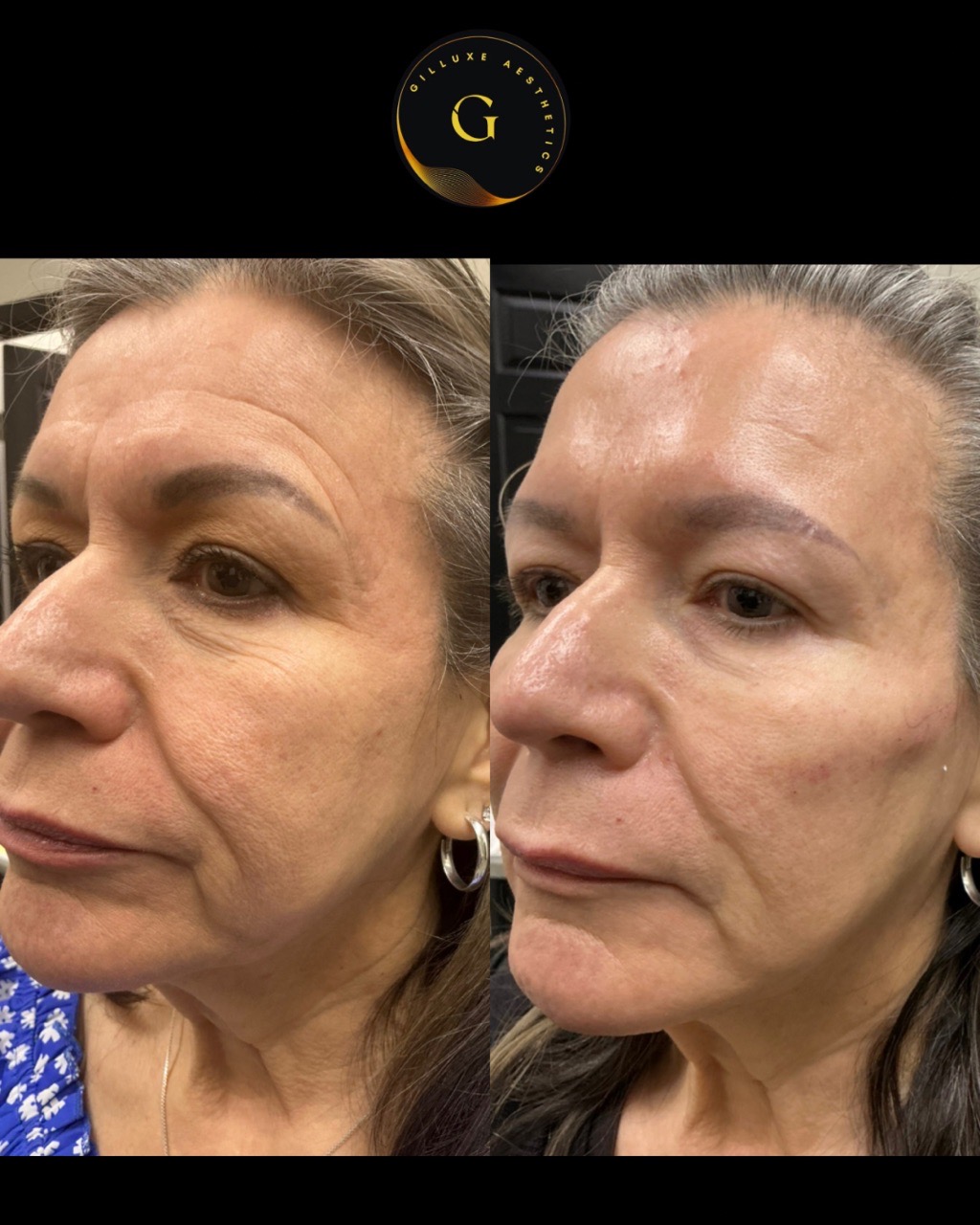 Skin Tightening Face
