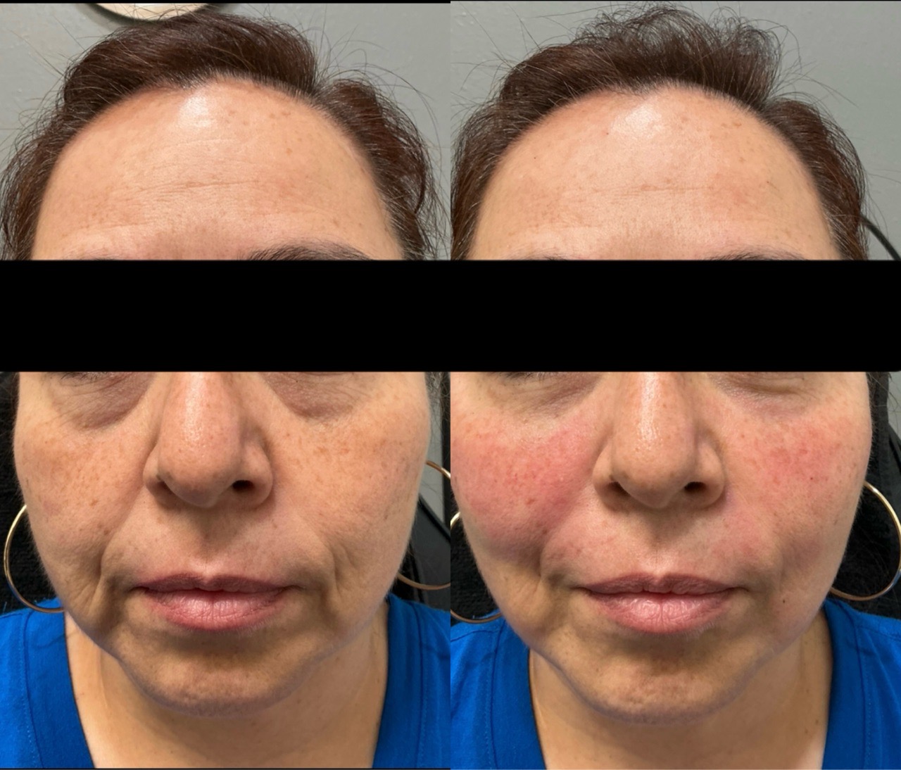 Skin Tightening Face