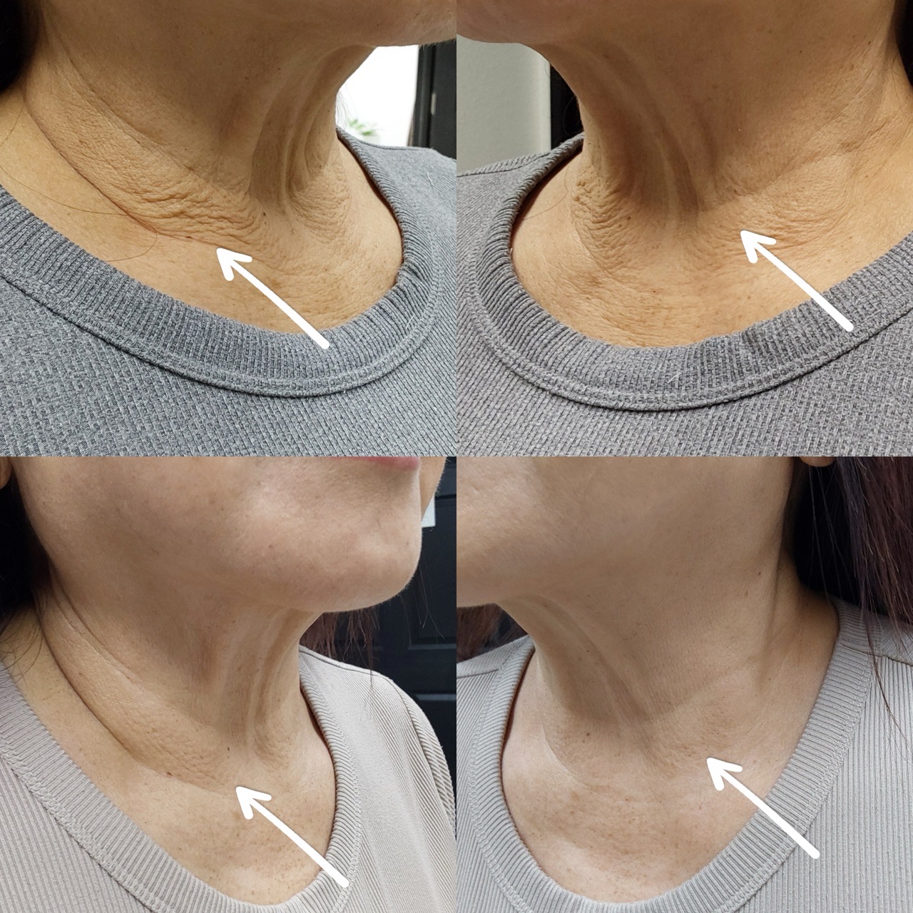 Neck RF Treatment