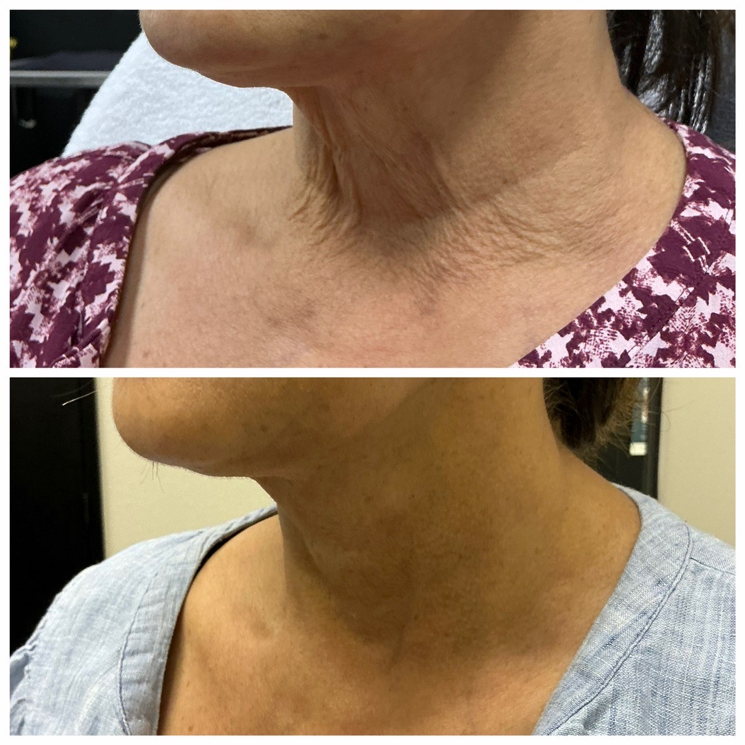 Neck RF Treatment