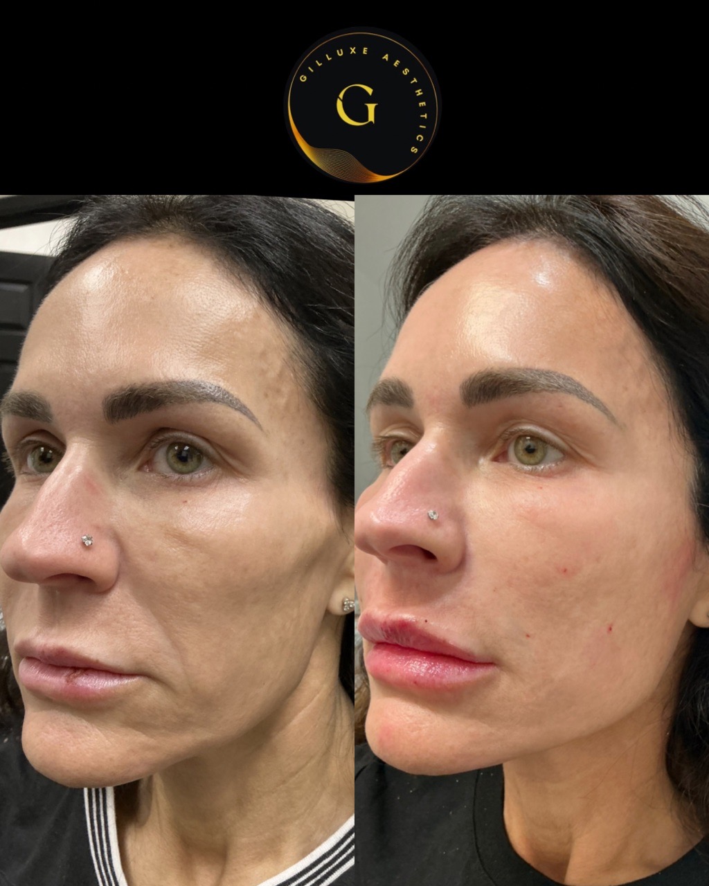 Skin Tightening Face