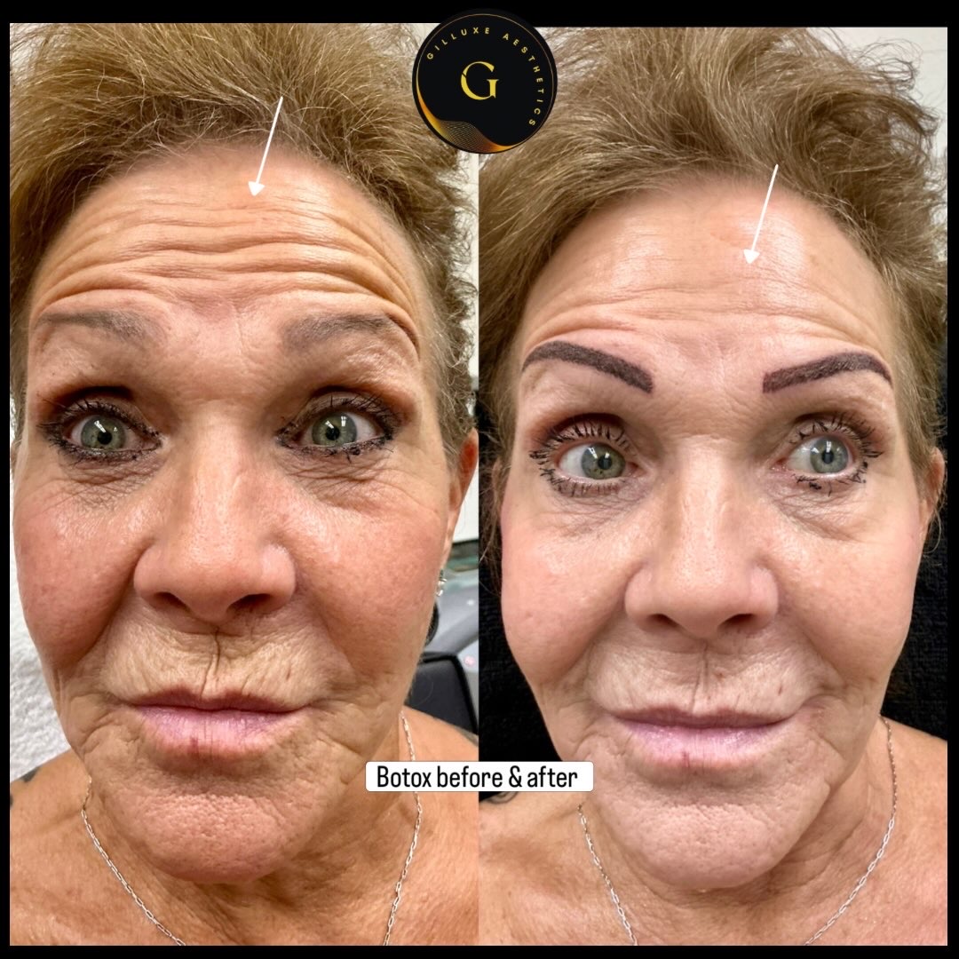 Skin Tightening Face