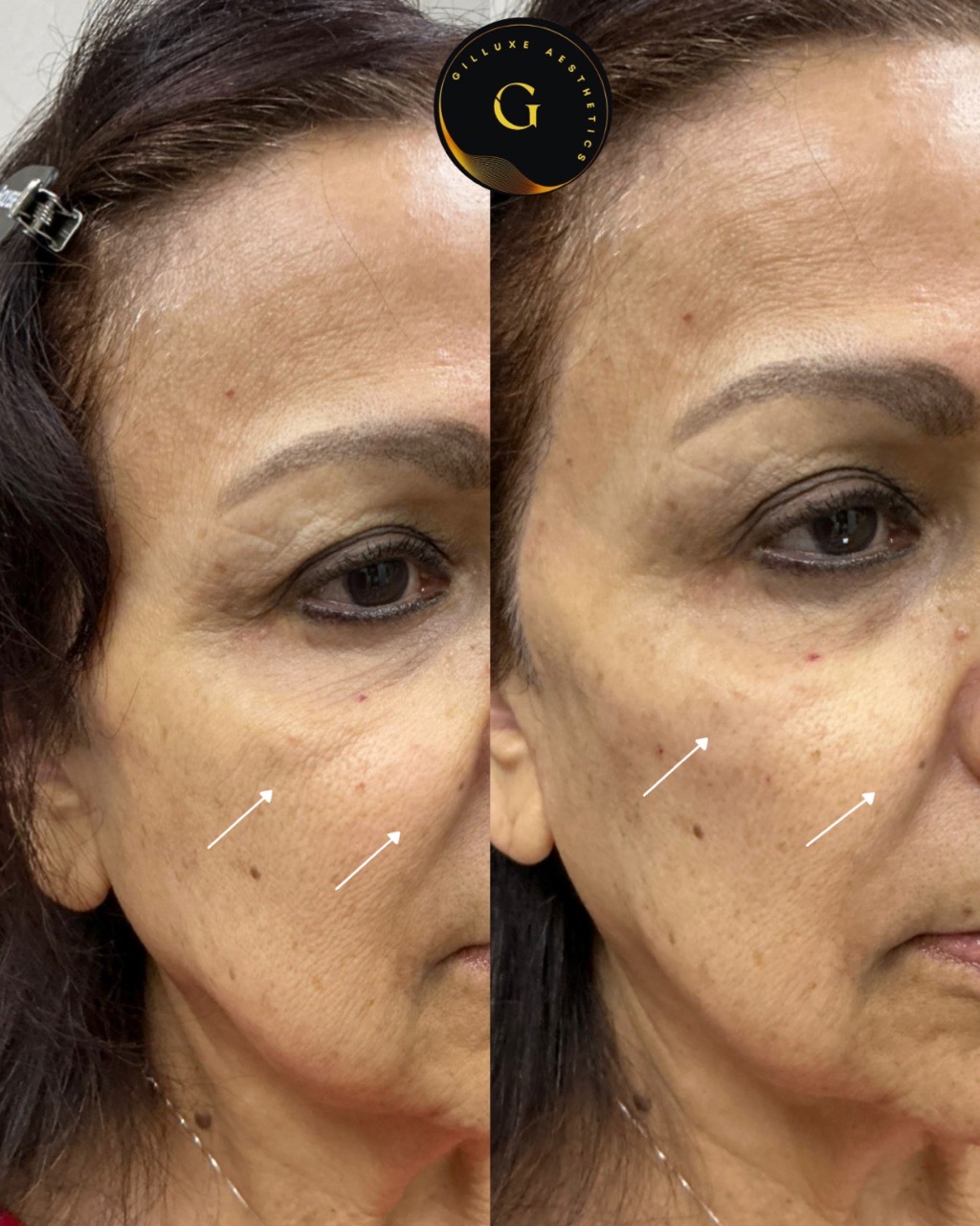 Skin Tightening Face