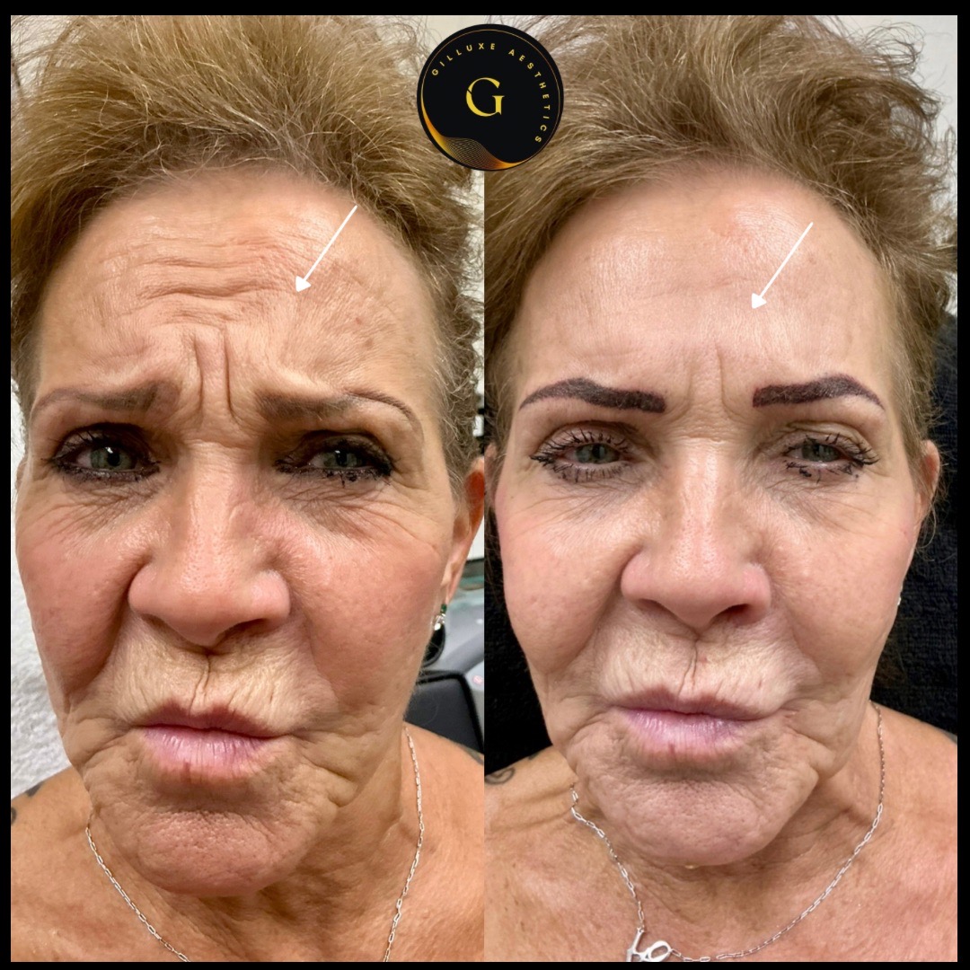 Skin Tightening Face