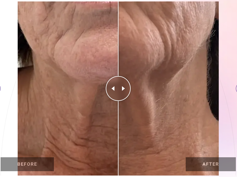 Back Sculpt & Smoothing Treatment