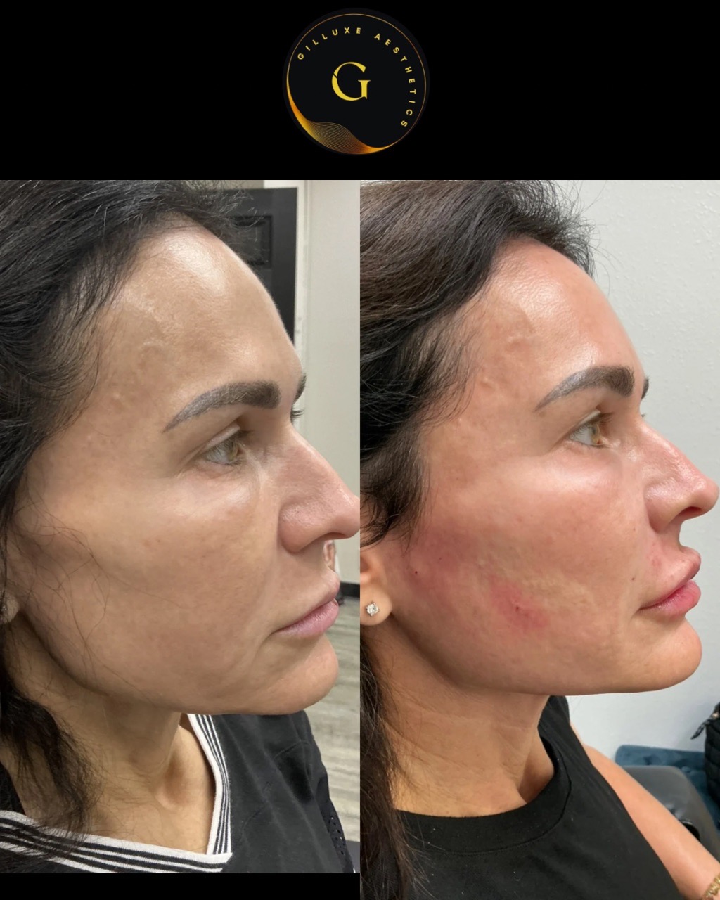 Skin Tightening Face