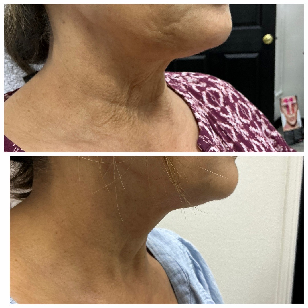 Neck RF Treatment