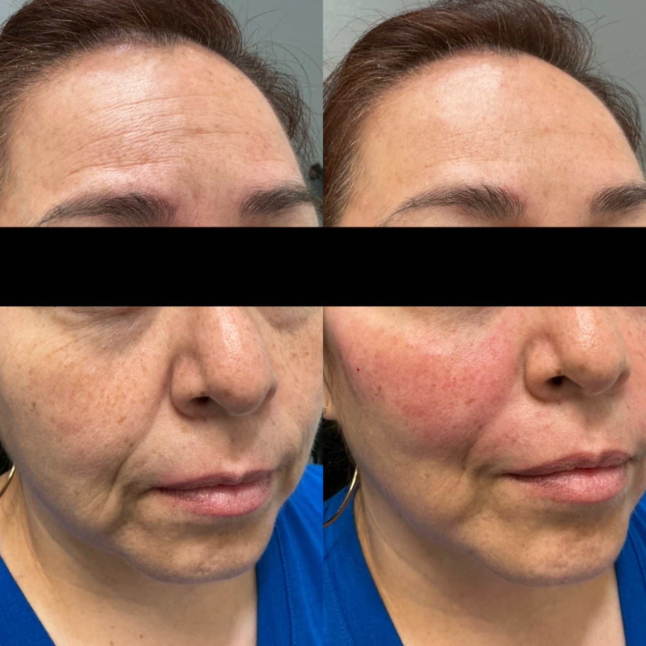 Skin Tightening Face