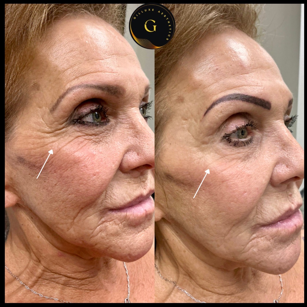 Skin Tightening Face