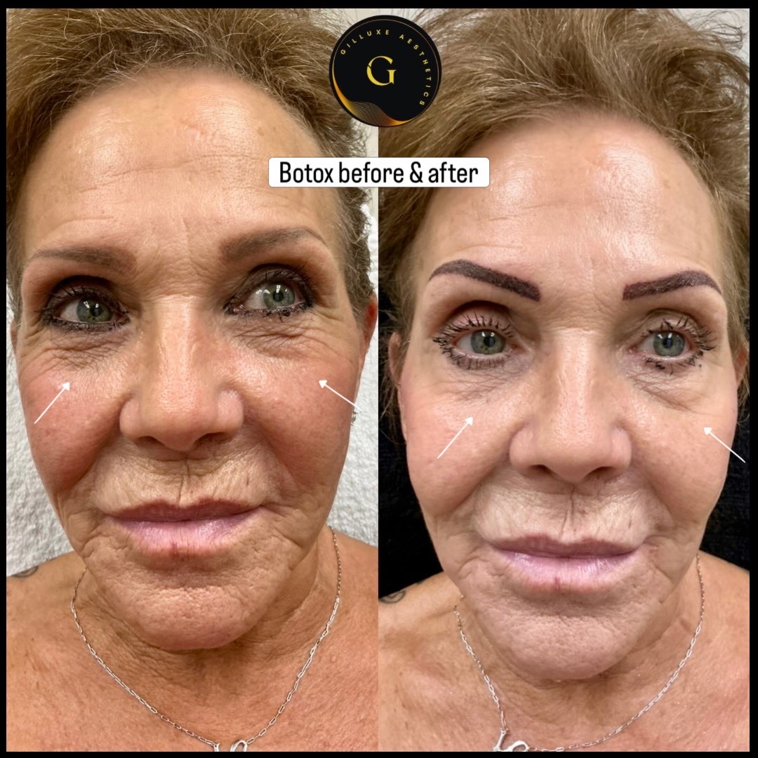 Skin Tightening Face