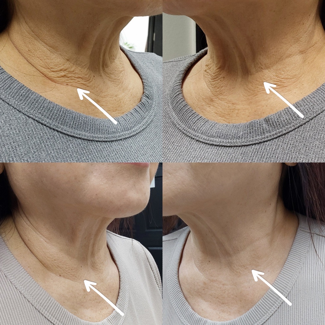 Neck RF Treatment