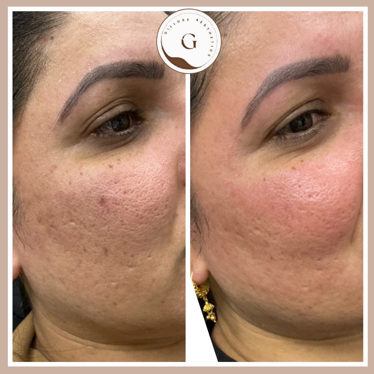 Microneedling