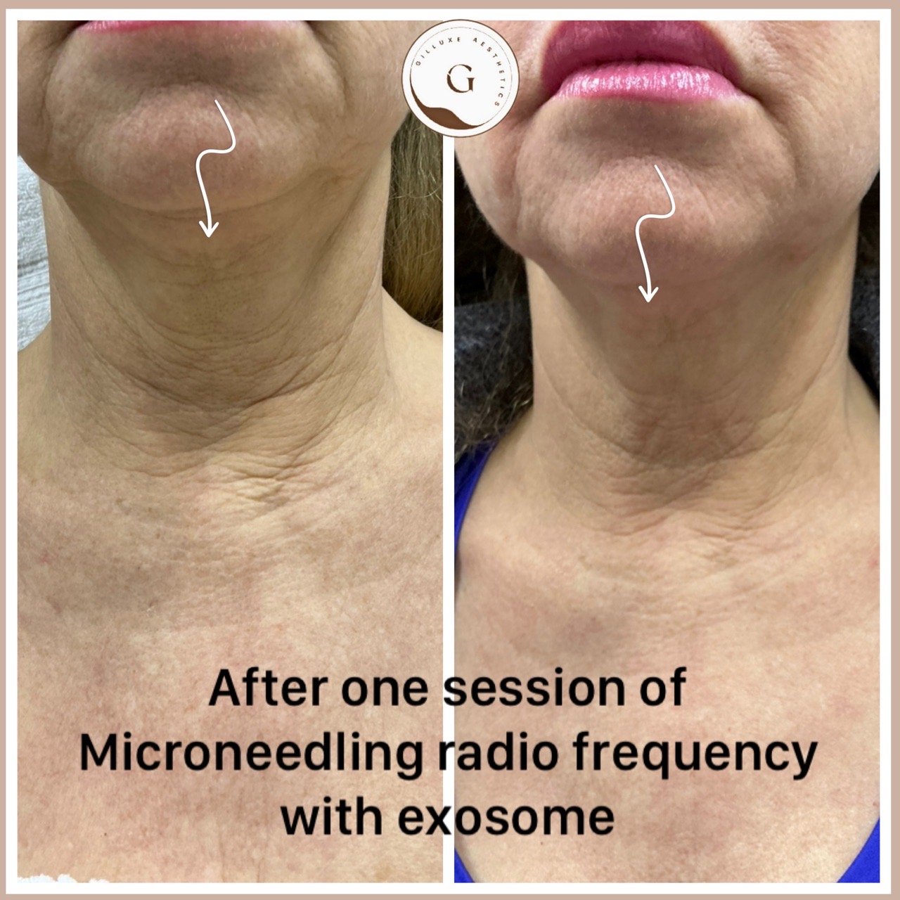 Neck RF Treatment