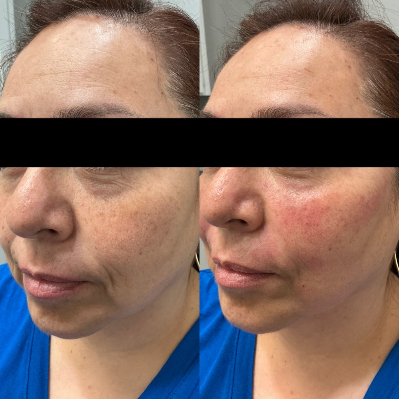 Skin Tightening Face
