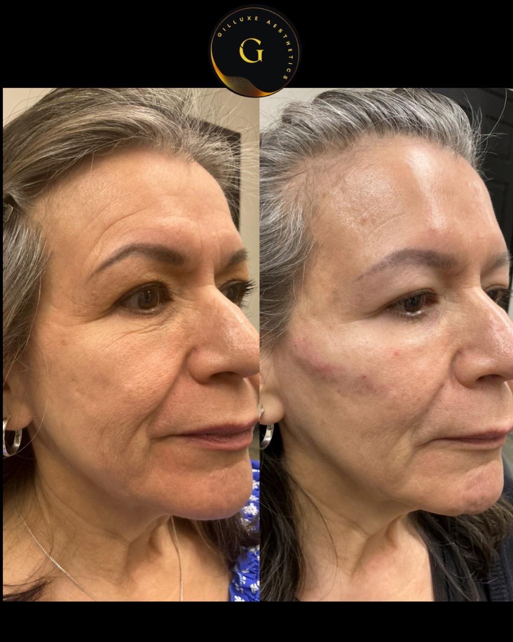 Skin Tightening Face
