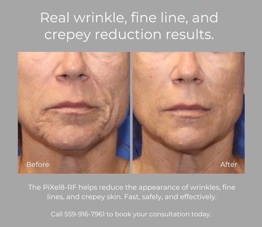 Neck RF Treatment