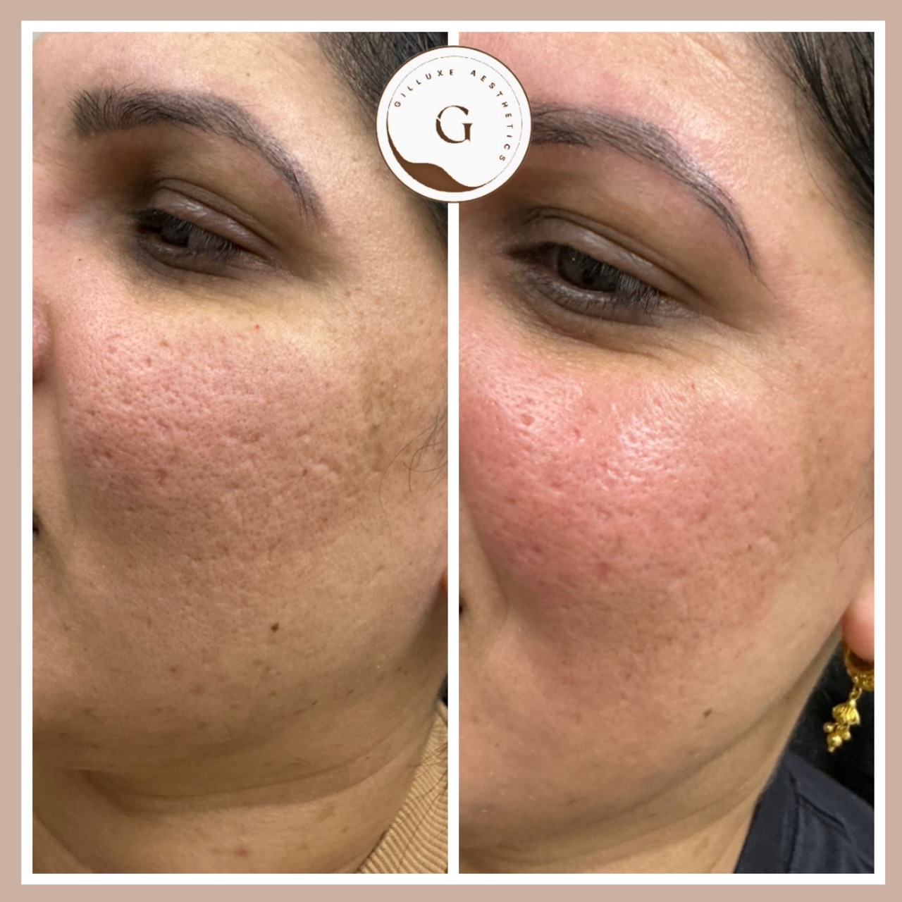 Microneedling