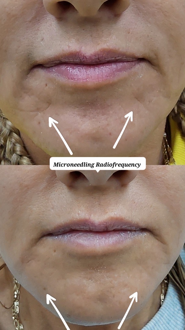 Microneedling